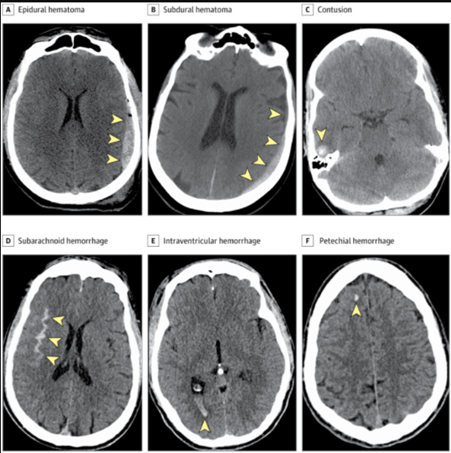 JAMA Neurology：轻度脑创伤不可小觑，1年内要定期复查CT