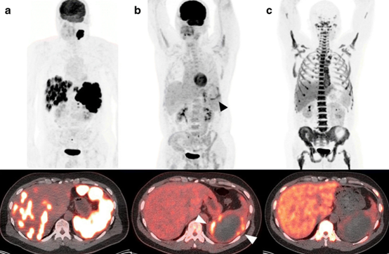 iFLT-PET/CT是弥漫<font color="red">性</font>大B细胞<font color="red">淋巴瘤</font>化疗免疫治疗后无进展生存率的早期和优越预测指标