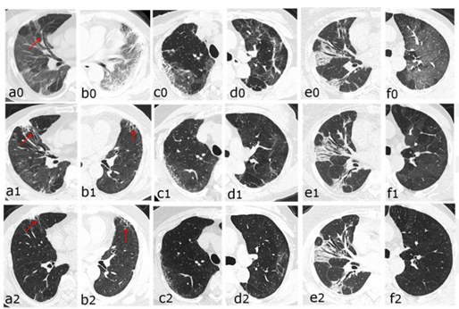 Radiology：CT随访发现重度COVID-19幸存者<font color="red">肺</font>间质异常持续存在