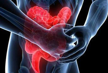 IBD：炎症性肠病患者的结直肠狭窄不能预测结直肠肿瘤一定会发生