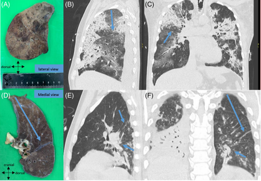 Respirology:COVID-19患者CT表现正常的局部肺组织也可能存在病变