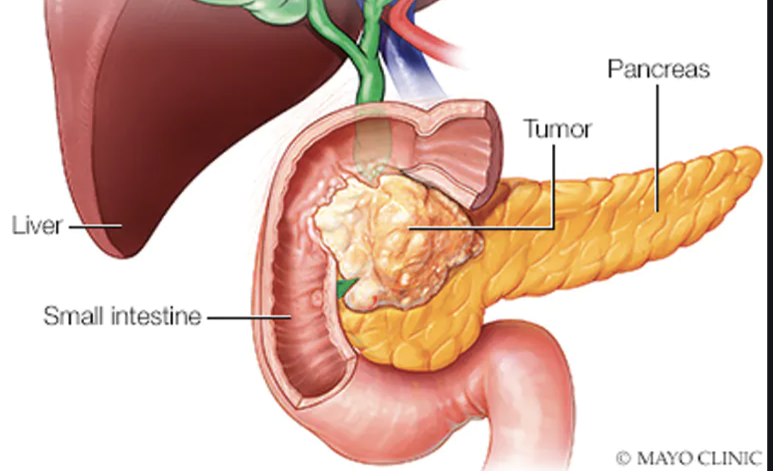 npj Precision Oncology ：研究员发现了一种胰腺癌的生物标志物！