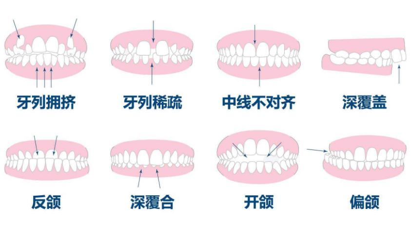 Nutrients：维生素D3或可促进牙齿和面部骨骼的正常发育，预防错<font color="red">牙</font><font color="red">合</font>！