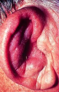 “没骨气”的耳朵——复发性<font color="red">多</font>软骨炎，好发于40-55岁！