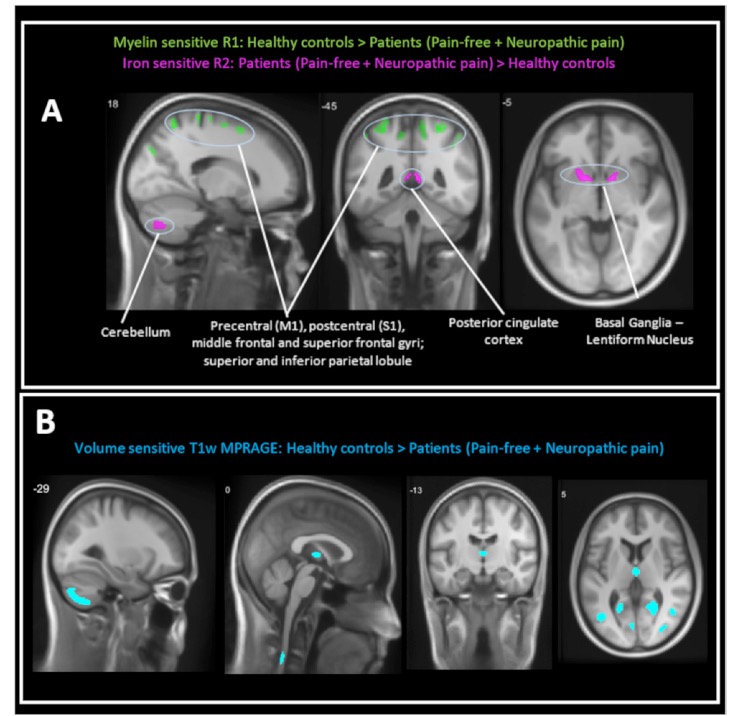 JNNP：脊髓损伤后，神经病理性疼痛的机制新发现