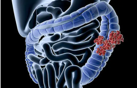 Br J Cancer：治疗后炎症相关生物标志物与结直肠癌患者生存之间的关联性研究