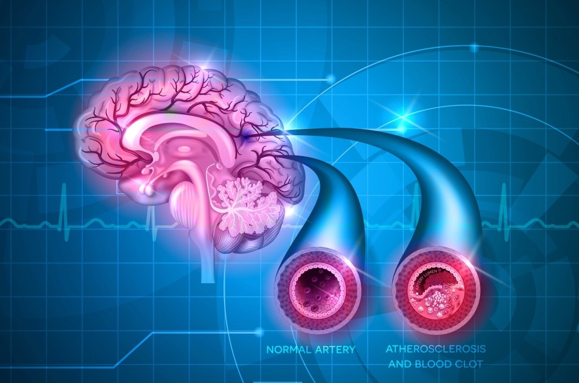 Journal of stroke:大血管<font color="red">堵塞</font>导致的轻微脑卒中，早期神经系统恶化的预测因素有哪些？