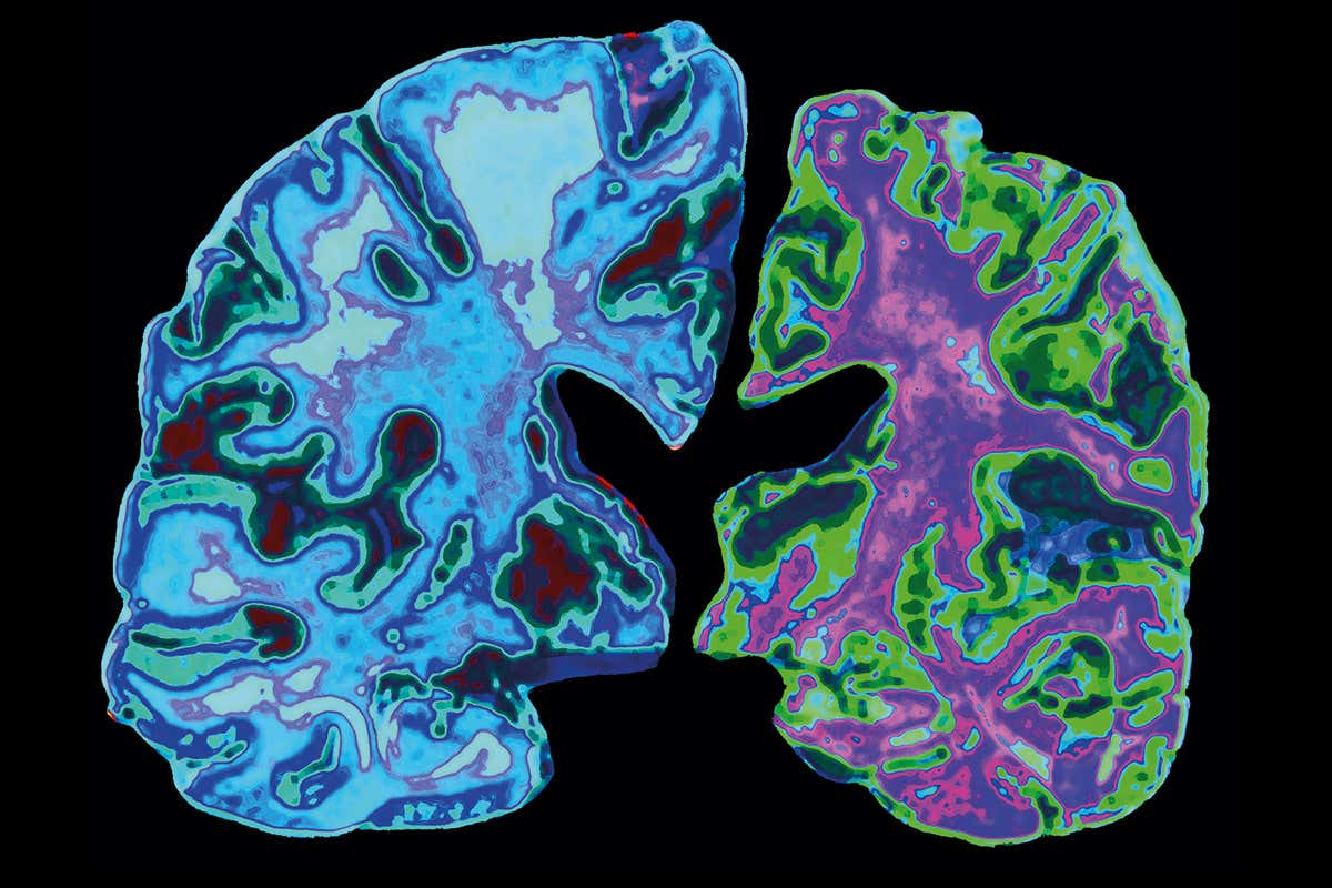 Alzheimers Dementia：心血管危险<font color="red">因素</font>和痴呆风险高度相关