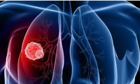 Cell Death Dis：miR-526b-3p抑制肺癌的顺铂耐药和转移