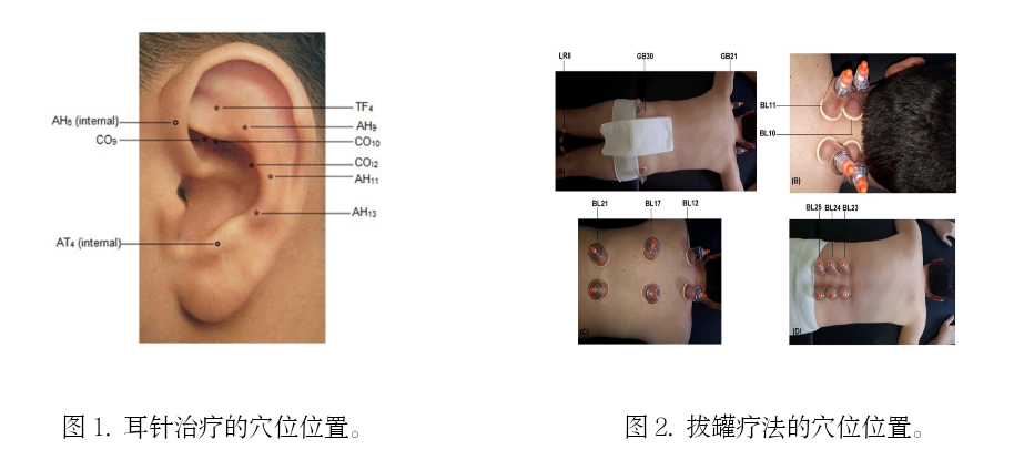 A randomized clinical trial：耳针配合拔<font color="red">罐</font>治疗更能改善慢性背痛