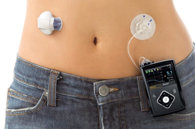 Diabetes Care：1型糖尿病患者新选择——无管、体内自动胰岛素输送系统来试试！