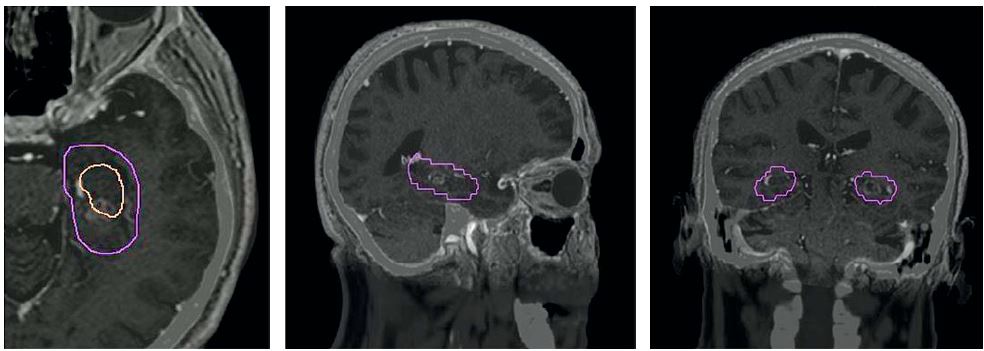 J Clin Oncol：预防性脑放疗时避开海马区可在不降低预后的情况下保护认知功能
