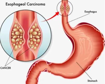 Gastroenterology：颠覆！T1bN0M期食管鳞癌患者采用放化疗治疗的效果不劣于手术！