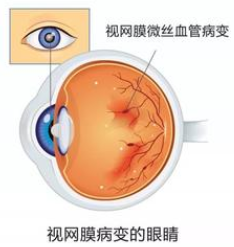 EClinicalMed：ω-6/ω-3多不饱和<font color="red">脂肪</font>酸比是鉴别有无糖尿病视网膜<font color="red">病变</font>的理想生物标志物