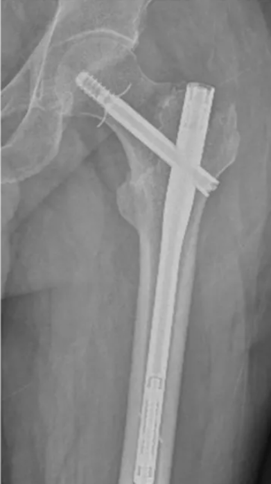 这种新型“带爪”髓内钉，能否有效固定粗隆间骨折？