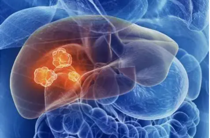 Nat Cancer：新辅助治疗药物卡博替尼和纳武单抗治疗局部晚期肝细胞癌