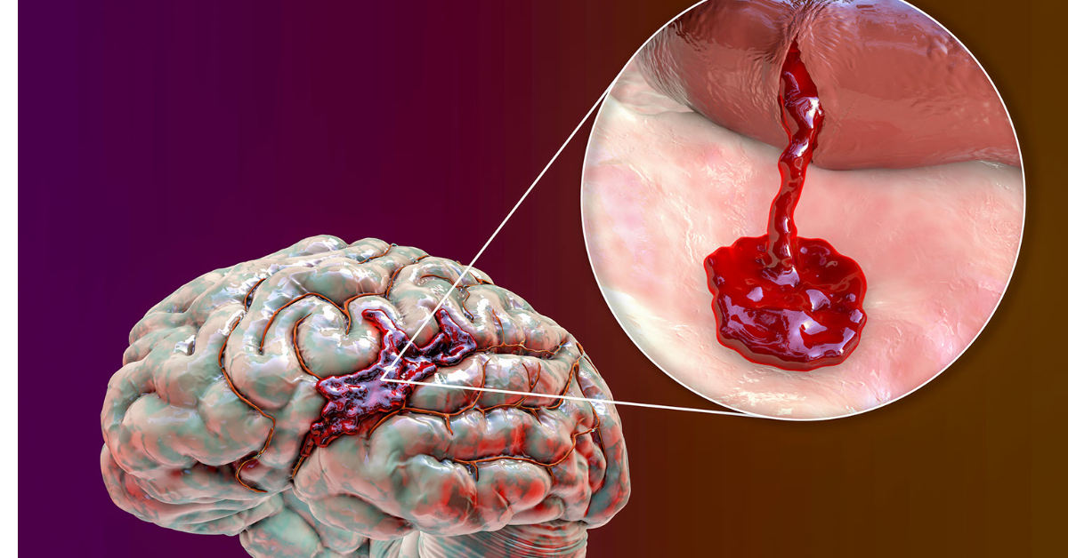多学科诊治指南速看：出凝血功能障碍相关性脑出血