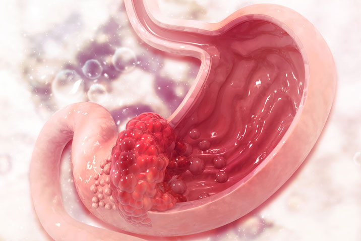 Gastroenterology：一项近3万<font color="red">中国</font>人研究，这些行为导致了一半的胃癌发生！