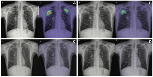 Radiology:深度学习，使影像学评估肺<font color="red">结核</font>的活动性成为可能！