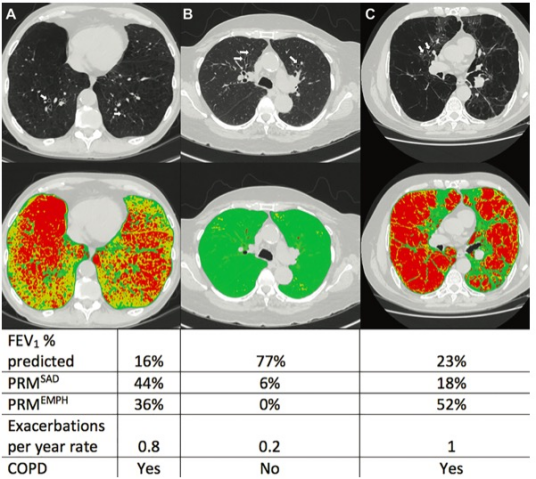 Radiology：“吸烟者的肺”：为<font color="red">支气管</font><font color="red">扩张</font>患者敲响警钟！