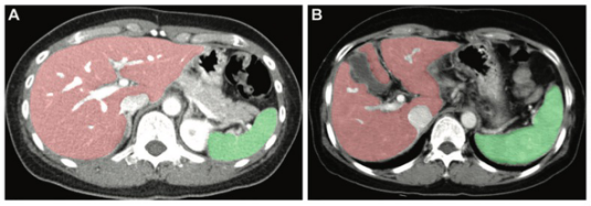 Radiology：健康个体和病<font color="red">毒性</font>肝炎患者肝脏和脾脏体积的个性化参考区间