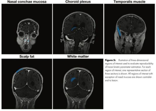 Radiology：高级别胶质瘤患者的<font color="red">全</font><font color="red">脑</font>动态对比增强MRI评估