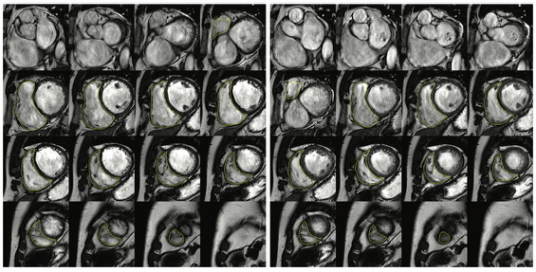 Radiology：心脏MRI测量的右心室功能在植入式心律转复器患者评估中的价值