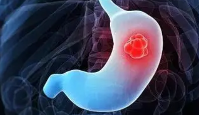 Gastric Cancer：纳武单抗在进展期胃癌中的真实临床疗效