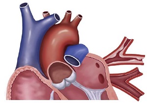 JACC：经导管肺动脉瓣置换术后心内膜炎的发生率、危险因素及预后