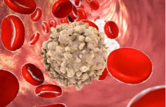 Leukemia：供体来源的NK细胞可降低异基因造血干细胞移植后癌症患者的复发率