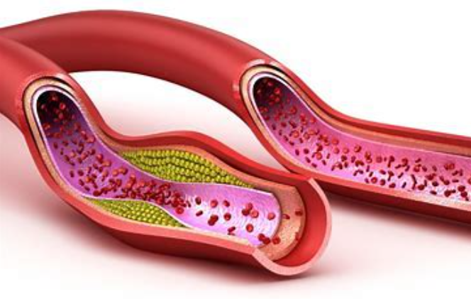 Circulation：载脂蛋白B与冠状动脉疾病和外周动脉疾病风险的相关性