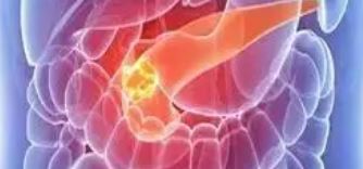 Clin Gastroenterol Hepatol：胰腺癌发生前三年血糖和体重的变化