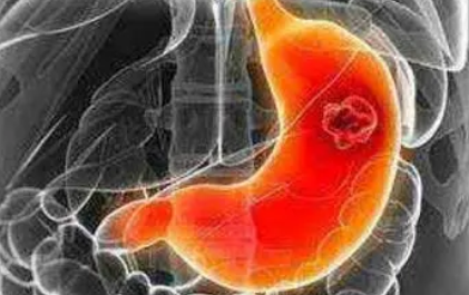 Gastric Cancer：甘油三酯-<font color="red">葡萄</font>糖指数与胃癌风险的相关性