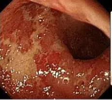 Clin Gastroenterol Hepatol：结直肠狭窄在溃疡性结肠炎患者中的发生率及相关风险因素