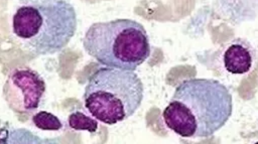 Clin Cancer Res：国产BTK抑制剂泽布替尼治疗难治/复发性Waldenström巨球蛋白血症的疗效和安全性