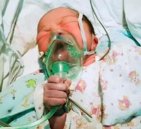 Pediatrics：早产儿拔管后的吸氧方式对比