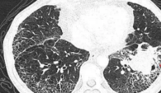 Lancet Respir Med：注意！加用环磷酰胺对特发性肺纤维化急性加重患者而言有害无利！