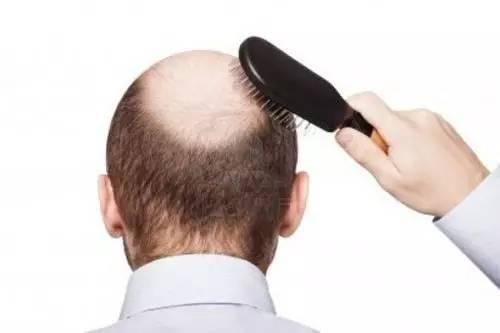 JAAD: 男性女性型脱发：雄激素性脱发的一种独特临床变异。