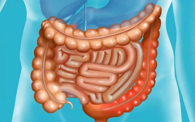 Clin Gastroenterology H: 什么才是溃疡性结肠炎中结直肠狭窄的危险因素？