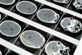 JAMA Neurol：全麻状态丘脑下核深部脑刺激对帕金森患者临床症状的影响