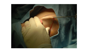 JEADV:皮下激光与浅表抽脂术治疗腋臭的比较