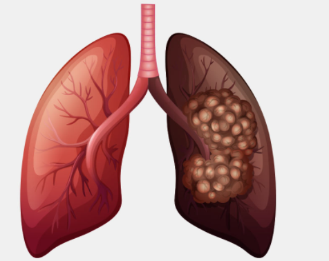 Lancet子刊& WCLC：<font color="red">单</font><font color="red">次</font>胸部CT筛查，就能降低1/3肺癌死亡率！