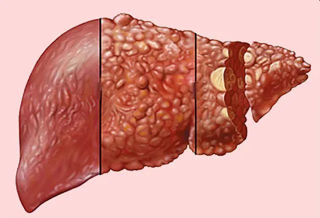 JGH: 术后连续三天使用抗生素可以降低乙型肝炎病毒相关肝细胞癌肝切除术后的感染率