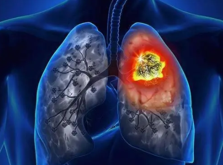 J Immunother Cancer：接受免疫检查点抑制剂治疗的癌症患者患肺结核的风险比普通人高 8 倍！