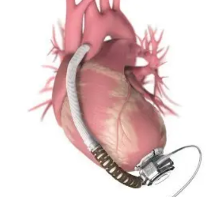 JACC：老年心衰患者植入<font color="red">左心室</font><font color="red">辅助</font>装置(LVAD)后的临床预后