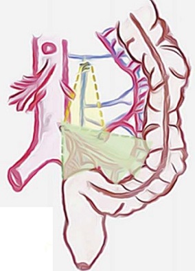Ann Surg：与标准全结肠系膜切除术相比，扩大全结肠系膜切除术治疗乙状结肠癌弊或大于利！