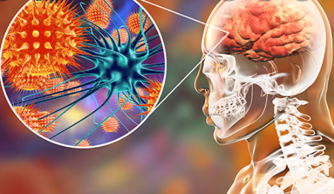 JAMA Neuro：“万金油”免疫治疗真的万能！来看看NMDAR抗体脑炎IVIG的疗效