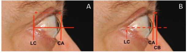 Thyroid:Graves眼病患者使用前列腺素F2-α<font color="red">滴眼液</font>（比马前列素）
