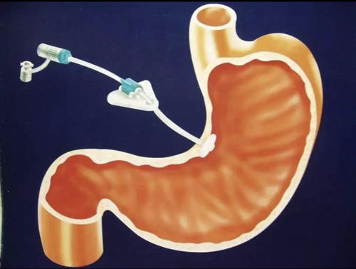 AJG:抗血栓治疗不影响经皮内窥镜胃造瘘管放置期间患者的死亡率