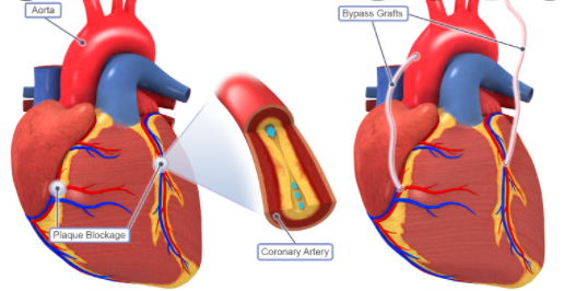 Circulation | 阜外医院：非接触式静脉采集CABG术显著降低了移植静脉阻塞的风险！
